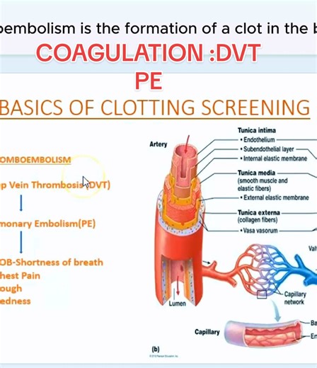 Understanding Hypercoagulable States and Thromboembolism