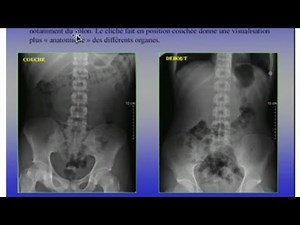 ABDOMEN SANS PREPARATION(ASP)☢️