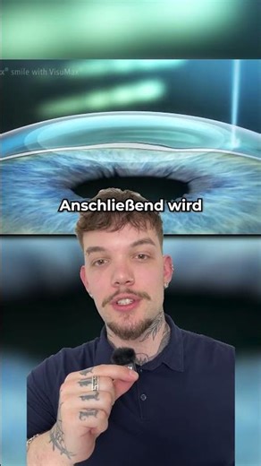 Was ist die ReLEx SMILE-Methode?