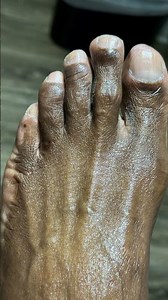 Fungal toenail infection can be cured #podiatry #fungalnails #treatment #curentaffairs2021