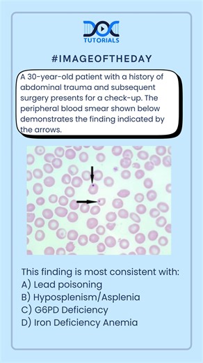"What Does This Blood Smear Finding Indicate in a Patient with Abdominal Trauma?"