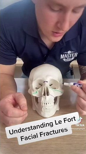 Understanding Le Fort Facial Fractures