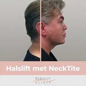 Halslift voor en na - NeckTite behandeling door ReSculpt Clinic bij Teun Föhn
