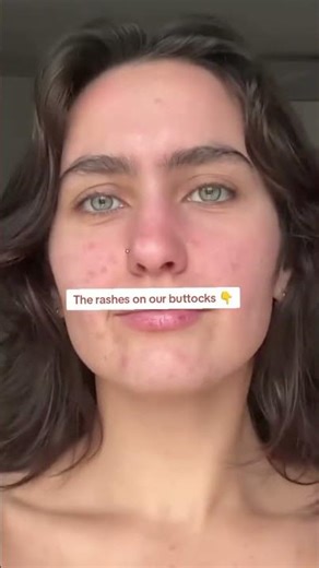 The rashes on our buttocks