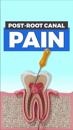 Pain after a Root Canal Treatment: Causes and When to Worry