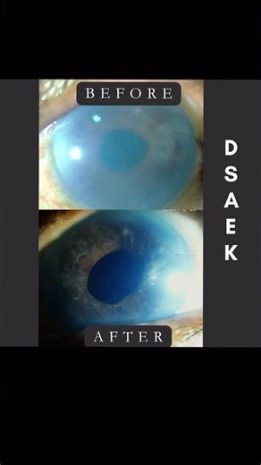 DSAEK - corneal transplant surgery