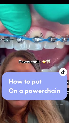 how we put a powerchain on #braces #smile #orthodontist