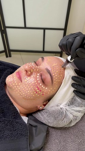 Have you tried BB Glow? Insta: Glow_bysarah_ to see some amazing results! #fyp #beauty #skincare #esthetician #bbglow #bbglowtreatment #nanoglow #spa