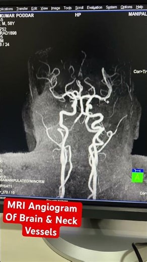 MRI Angiography of Brain & Neck Vessels MR Neck Angiography