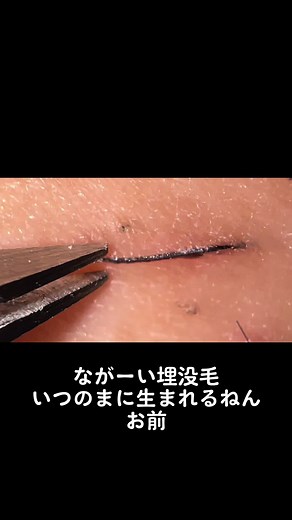 長い埋没毛の毛抜き職人技
