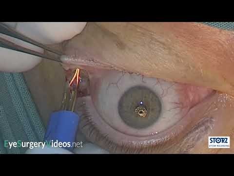 Lower lid transconjunctival fat blepharoplasty