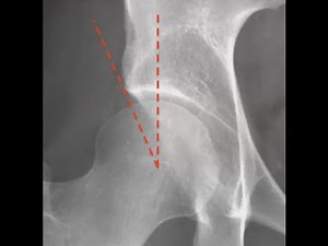 Lateral Center Edge Angle