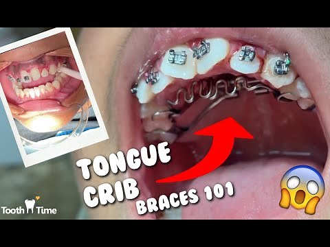 Dental Braces: Tongue Crib + RPE - Tooth Time New Braunfels Texas Orthodontics