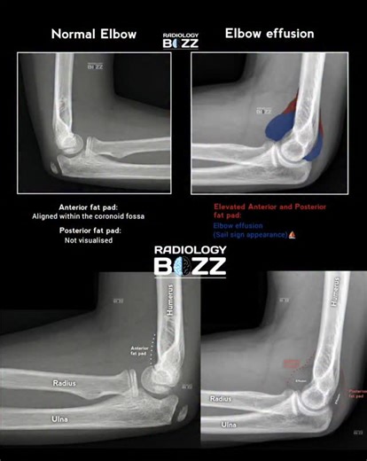 🦴 Elbow X-ray: Normal vs Elbow Effusion (Fat Pad Sign) 🩻 This lateral elbow radiograph beautifully demonstrates the difference between a normal elbow and elbow joint effusion. 🔍 Key Radiographic Findings: ✅ Normal Elbow Anterior fat pad lies flat within the coronoid fossa Posterior fat pad is not visible (normal finding) ⚠️ Elbow Effusion Elevated anterior fat pad Visible posterior fat pad Classic “Sail Sign” appearance ⛵ ➡️ Indicates joint effusion, commonly associated with occult fractures,