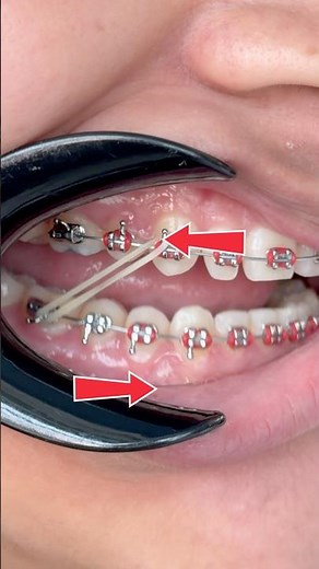 Most common rubber bands