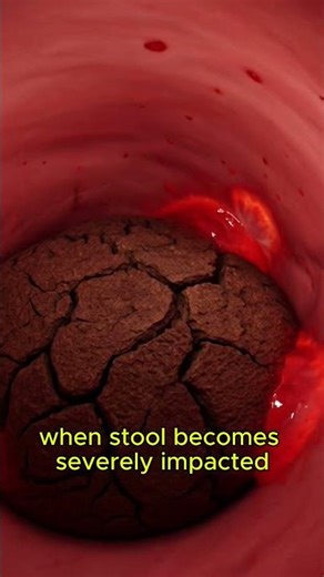 What Doctors Actually See During Colonoscopy
