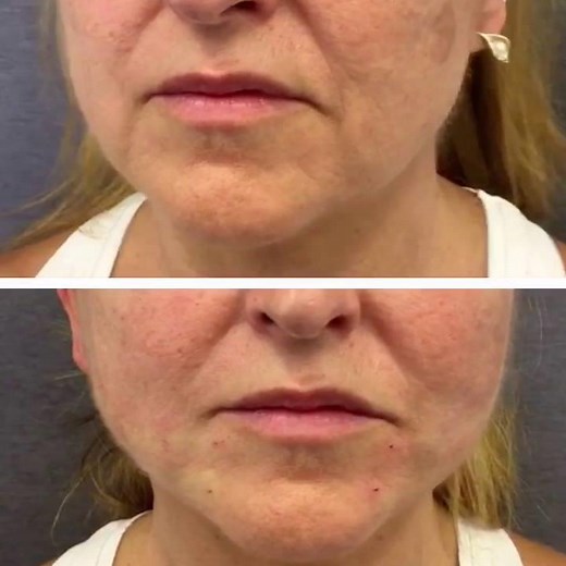 Hilos Tensores Happy Lift - Antes y después - Clinica CIME Barcelona y Badalona