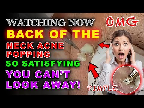 Back of the Neck Acne Popping – So Satisfying You Can’t Look Away!