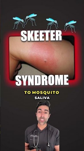Mosquito Bite To Take Seriosuly