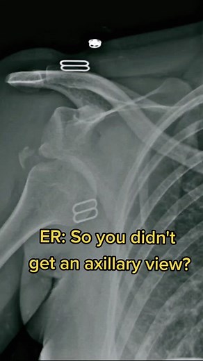 Velpeau View X-Ray of Arm Movement