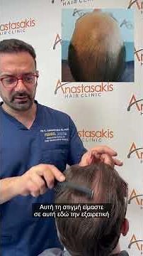 💥 Μεταμόσχευση μαλλιώων με 3.500 τριχοθυλάκια – Εντυπωσιακό αποτέλεσμα σε μόλις 10 μήνες! case #389