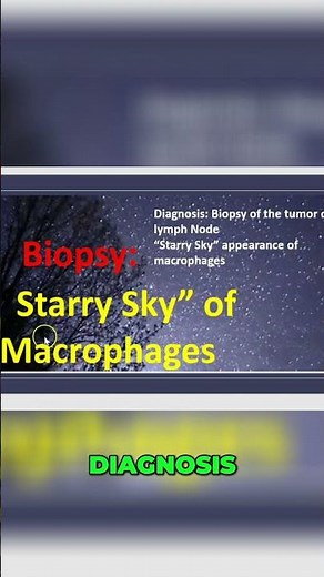 Burkitt Lymphoma: Causes, Diagnosis, and Treatment #shorts