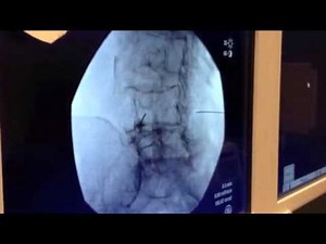 Bilateral Transforaminal Epidural Steroid Injection - Offered in Las Vegas, Nevada