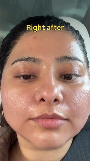 I Burned My Skin l(chemical peel) to Fix My Acne Scars… Before, During & After