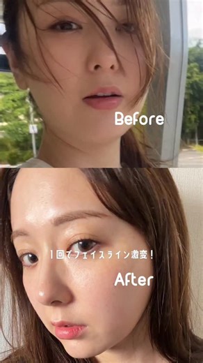 AMO on Instagram: "⟡ULINE CLINIC⟡ @ulineclinic_jp わたしの肉厚二重顎🌝施術翌日の変化に本当に驚いた...🌛 ☑️フェイスライン・ボディラインの改善に特化したクリニック ☑️韓国•アメリカで特許を取得したのオリジナルの脂肪溶解注射 "カット注射" (ステロイド・PPC 不使用 認証済み)が有名 ☑️最小限のダウンタイムで確かな効果を得られる！ ⚪️受けた施術 ・チタンカット注射 (チタニウムリフティング+Vカット注射) 📍서울시 강남구 선릉로 160길 7 ↪NAVERマップ🔎 [ユライン医院] 🚇狎鴎亭ロデオ駅4番出口徒歩2分 #ulineclinic #ユーラインクリニック#ユーライン #チタンカット注射 #韓国肌管理"