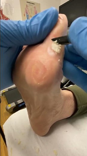 Watch this amazing transformation! 🌟 Wart debriding after salicylic acid treatment by a skilled