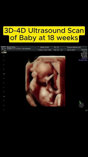 3D-4D Ultrasound Scan of Baby at 18 weeks #babykicks #babykicking #womenshealth #foryourpage #miracles #fyp #pregnancy #pregnant #birth #babiesoftiktok #babies #pregnancyweeks #pregnancyweekbyweek #wombmates #prenataldevelopment #Uterus #shorts
