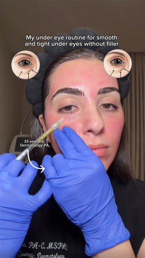 Mona Seresht, PA-C, MSPAS | LA Injector + Skincare on Instagram: "The secret sauce to my under eyes without filler (at least not yet). This is just one part of my regimen that targets my under eyes, so let me know if you want the full details! 💉🧴🩸"
