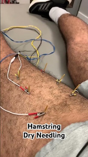 Hamstring Dry Needling for Hamstring Tear | Recovery & Pain Relief