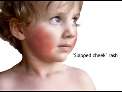 Erythema Infectiosum