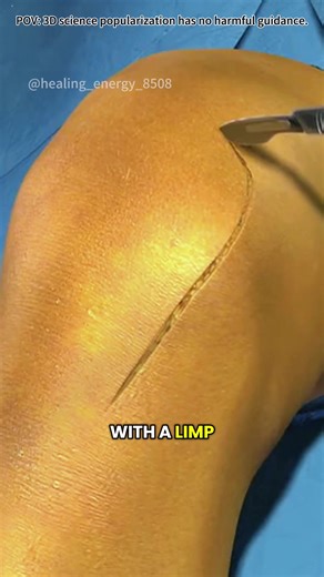 Total Knee Replacement Surgery (3D Animation) #kneereplacement #kneereplacementsurgery #totalkneereplacement #kneearthritis #kneejoint #kneetransplant #kneetransplantsurgery #medical3danimation #3dmedicalanimation