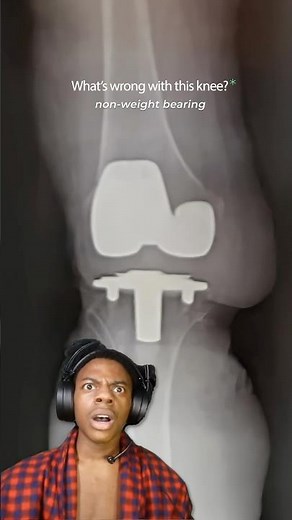 Why Knee Replacements FAIL - Case Discussion