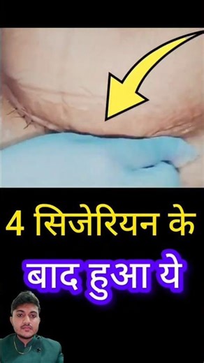 cesarean fact #cesareanbirth #cesareansection #csectionbirth