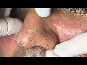 DEEP CLEANING: Warm your heart and relax with these results! #blackheadremoval #satisfying