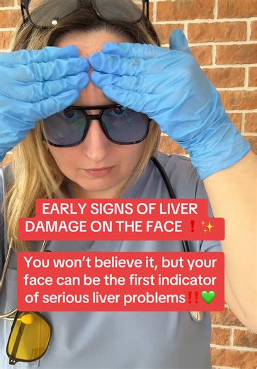 Early Facial Signs of Liver Damage You Shouldn’t Ignore Your face can reveal early warning signs of liver problems, including subtle yellowing of the eyes and skin or spider-like blood vessels. Learn what to look for and when to consult a healthcare professional. #LiverHealth #EarlySigns #HealthAwareness #MedicalEducation #PreventiveCare