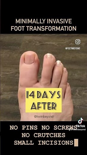 BEFORE & AFTER - MINIMALLY INVASVIVE BUNION SURGERY