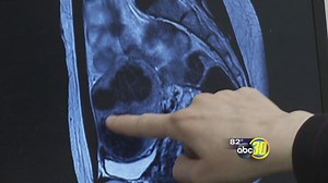 New treatment options shrink fibroids without major surgery