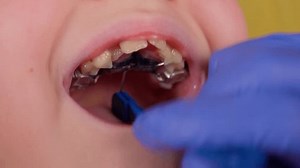 Setup Orthodontic Plate Child Mouth Palatal Stock Footage Video (100% Royalty-free) 1102760703 | Shutterstock