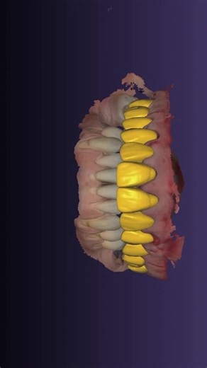 Dr.Amr Ramadan on Instagram: "Fp1 final tweaks #exocad #exoplan #cadcam #allonx #digital"