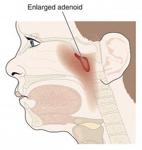 Enlarged Adenoids | Family Doctor