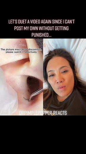 #duet with @aartgreen3 #SkinCare nice east#y blackheads & sebaceous filaments on skin with the most sebaceous glands 🙌🏼#drpimplepopper #SLMDskincare