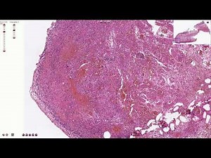 Hemorrhagic Infarction of the Intestine - Histopathology
