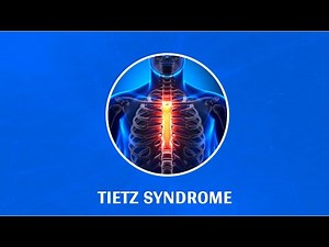 Rib Pain? It Could Be Tietze Syndrome! Learn More