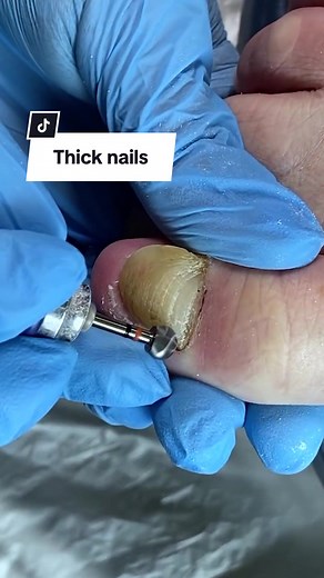 Dealing with Thick Toenails: Causes and Solutions