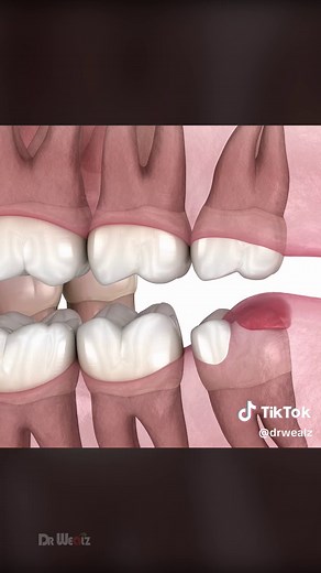Understanding Wisdom Teeth Removal: Reasons and Process