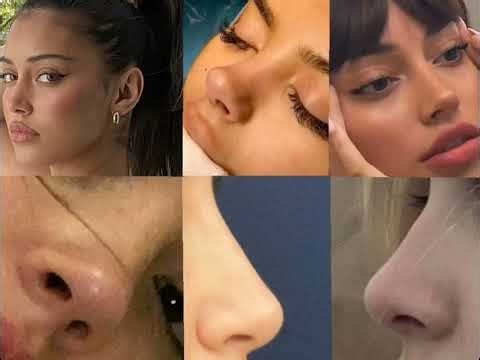 Nose subliminal (Symmetric, tiny, upturned)